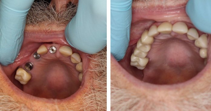Smile before and after dental implant tooth replacement
