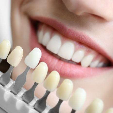 Smile compared with metal free dental restoration color options