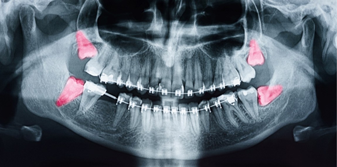 highlighted X-ray of impacted wisdom teeth in Laguna Niguel 