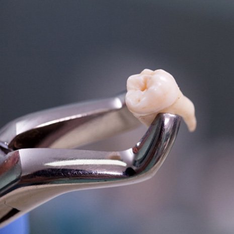 Closeup of tooth after wisdom tooth extraction in Laguna Niguel   