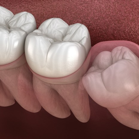 Diagram before wisdom tooth extraction in Laguna Niguel 