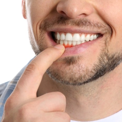 Man with periodontal disease pointing to inflamed gum tissue