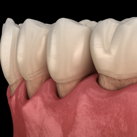 Animated smile with receding gums before scaling and root planing