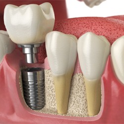 a graphic illustration showing how dental implants fuse with bone