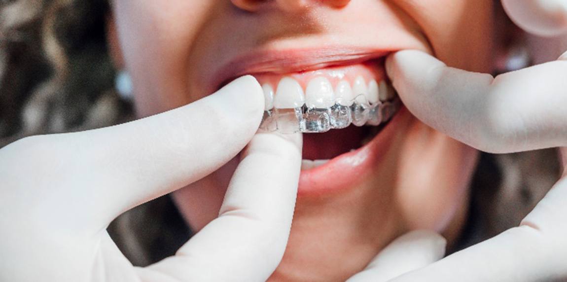 Dentist placing Invisalign clear aligner on patient's top teeth