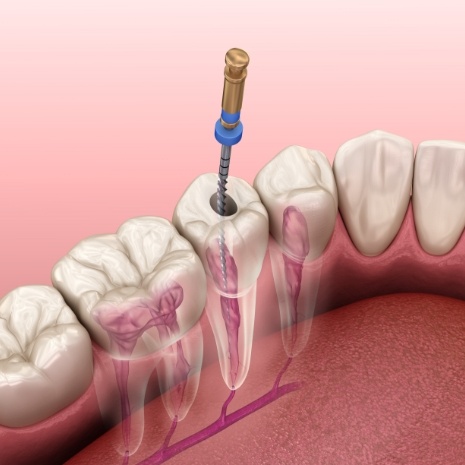 Animated smile during root canal therapy