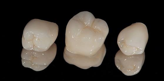 A close-up of dental crowns in Inver Grove Heights
