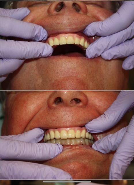 Smile before and after dental treatment