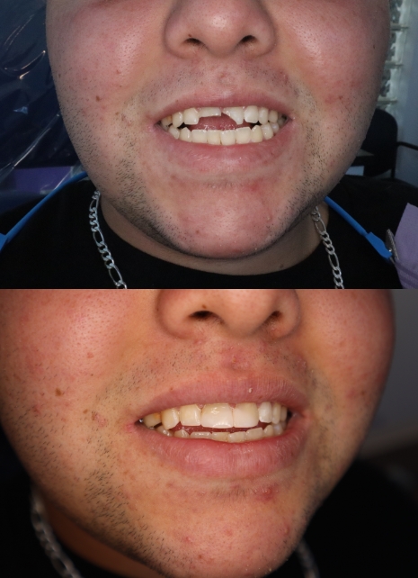 Smile before and after damaged front tooth repair